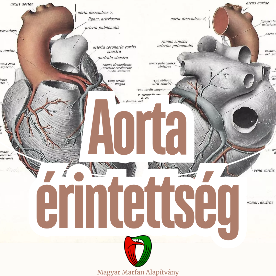 A Marfan-szindr�ma legfontosabb megnyilv�nul�sa az aorta (f�ver��r) �rintetts�ge.