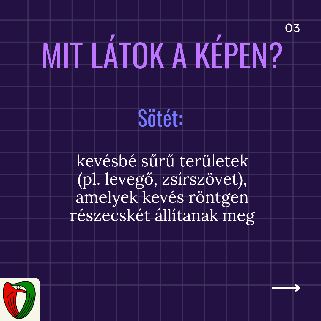 A kapott k�pen s�t�tebb �s vil�gosabb ter�leteket figyelhet�nk meg. Mit is jelentenek ezek?
A s�t�tebb ter�leten az anyagok kev�sb� �ll�tj�k meg a r�ntgen r�szecsk�ket (azok nagyobb mennyis�gben haladnak ott �t), emiatt ezek a r�gi�k s�t�tebbnek t�nnek.