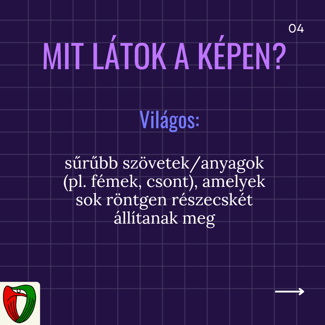 A vil�gos ter�leteken ennek az ellenkez�je t�rt�nik, az �rintett sz�vetek/anyagok (pl. csont, f�m eszk�z�k) nagyobb m�rt�kben �ll�tj�k meg a r�ntgen r�szecsk�ket, �gy ezek a r�gi�k vil�gosabbak lesznek a CT k�pen.