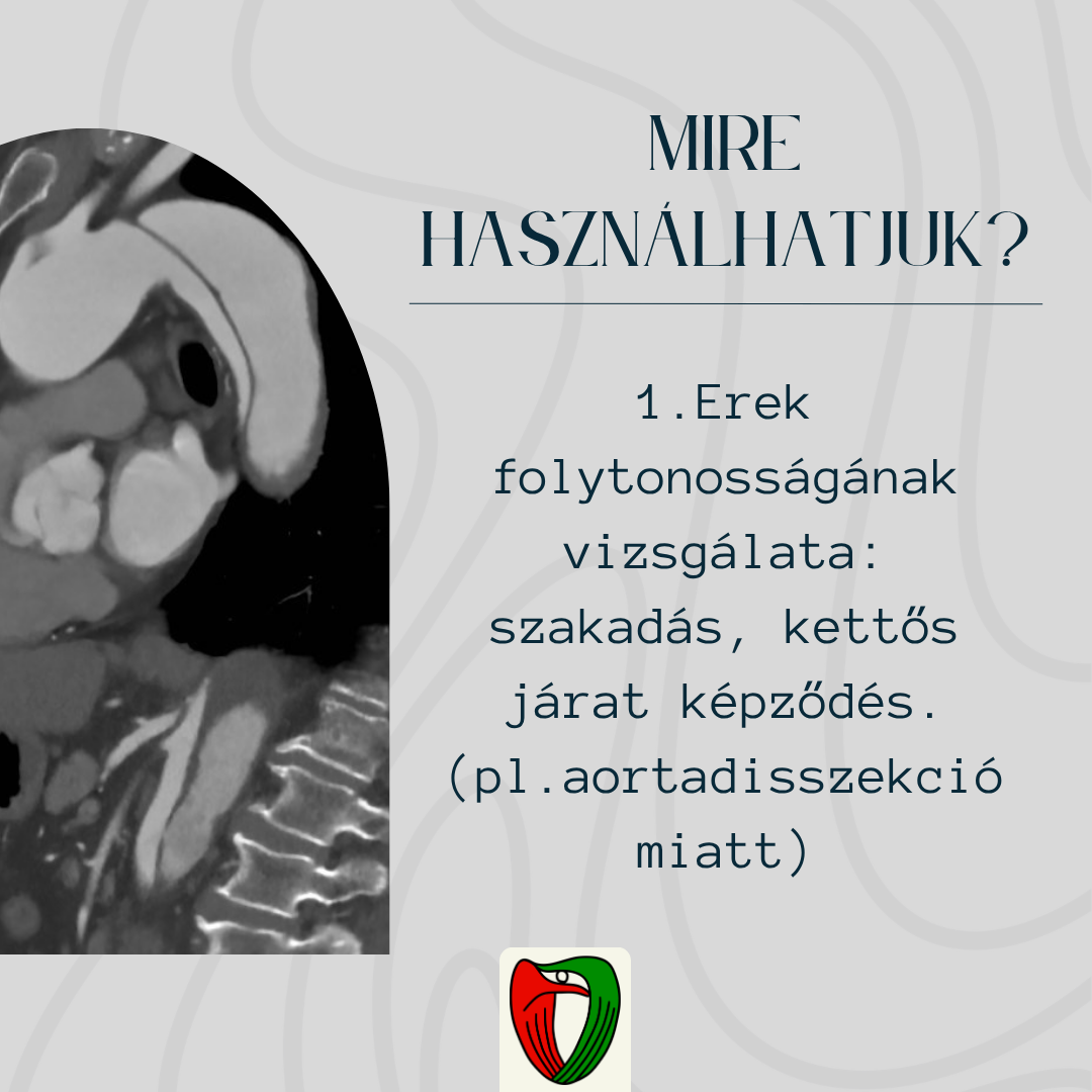 A CT angiogr�fi�t haszn�lhatjuk az erek folytonoss�g�nak vizsg�lat�ra: szakad�s, kett�s j�rat k�pz�d�s meg�t�l�se (pl. aortadisszekci� miatt). 