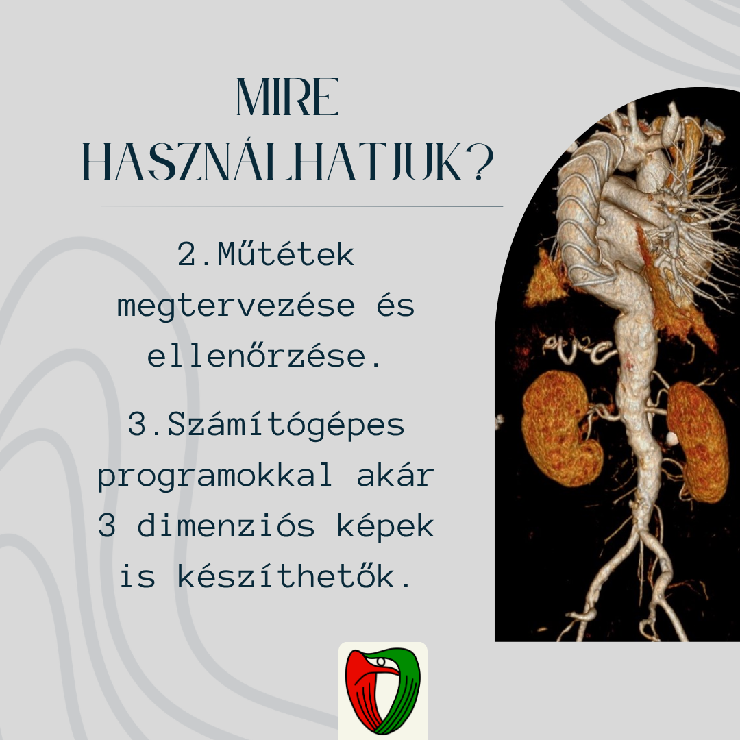 A CT angiogr�fia m�t�tek megtervez�s�hez �s a bevatkoz�s eredm�ny�nek ellen�rz�s�hez is kiv�l�an alkalmazhat�. K�l�nb�z� szoftverek seg�ts�g�vel ak�r 3 dimenzi�s rekonstrukci�k is k�sz�thet�k a felv�telekb�l.